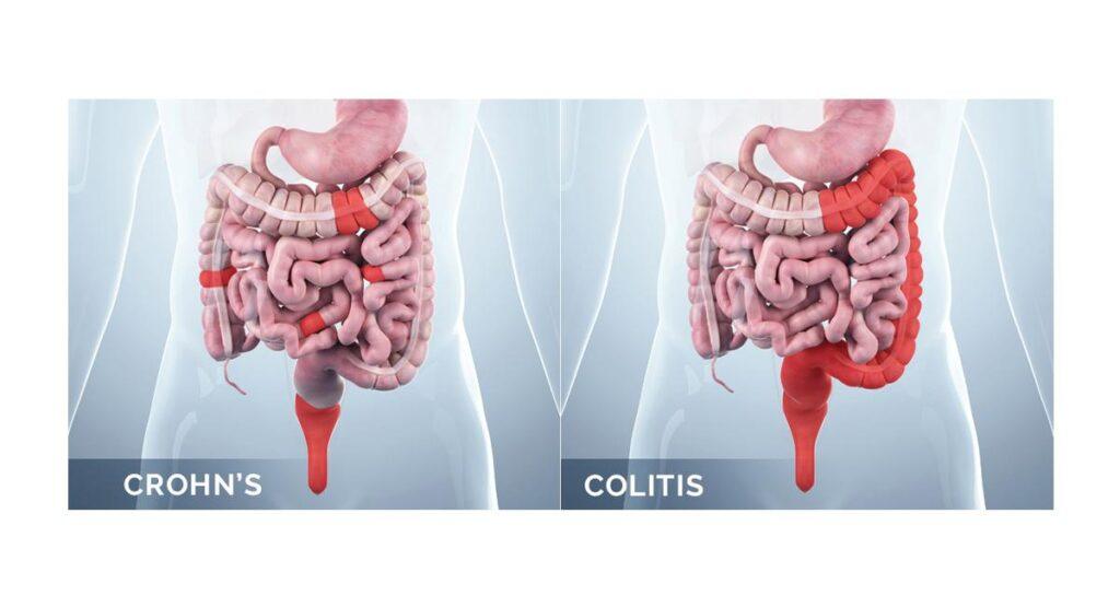 Treatment for Crohn’s Disease Smiles Gastroenterology