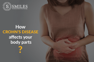 Crohn's Disease treatment