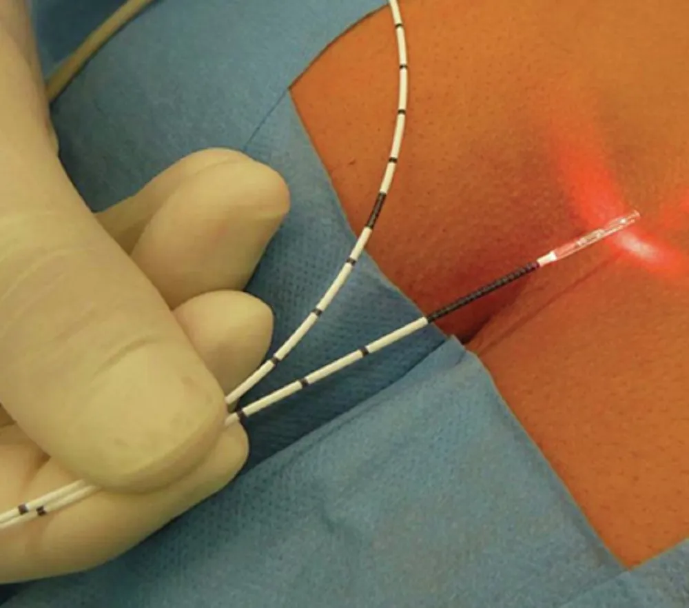 laser-treatment-for-fistula-an-analysis
