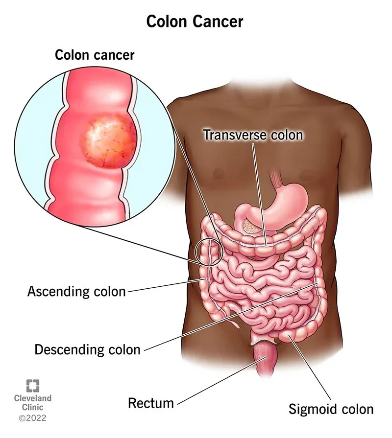 symptoms-causes-of-colorectal-cancer