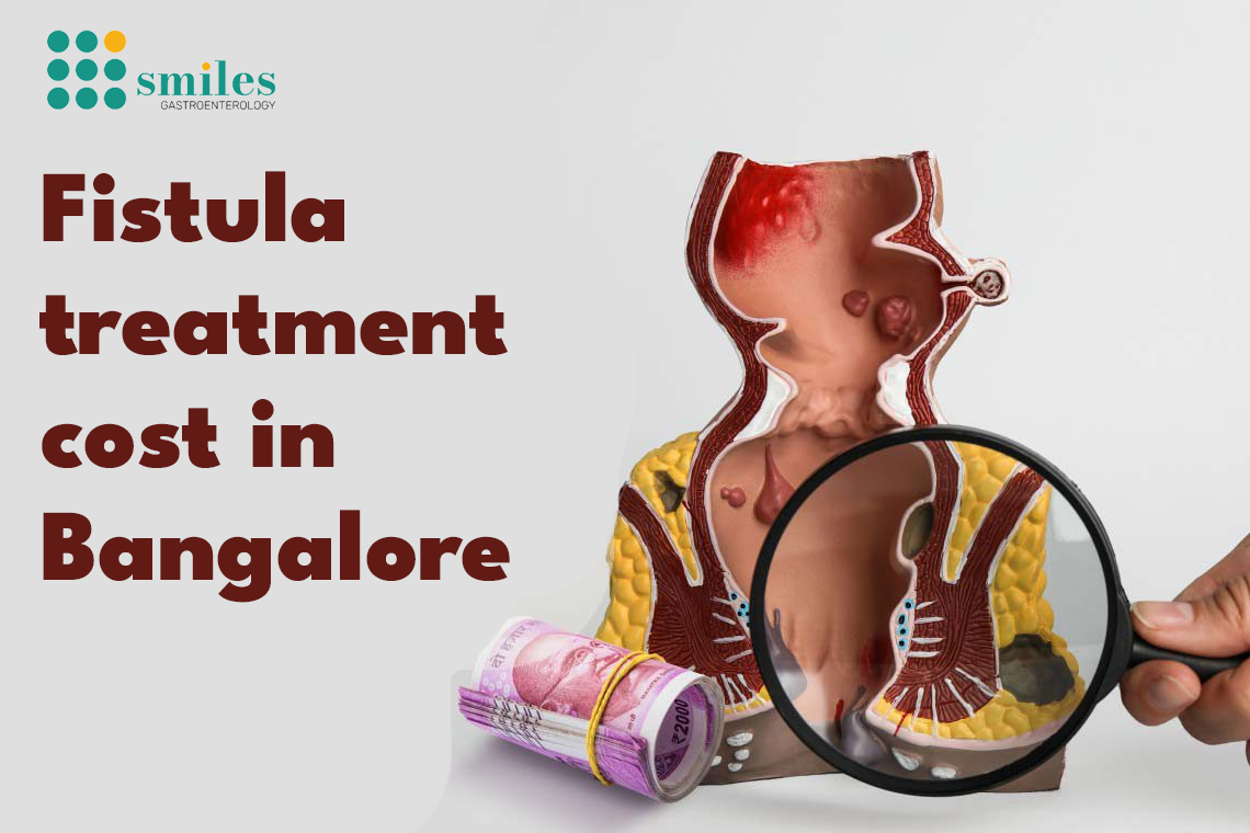 Fistula treatment cost in bangalore