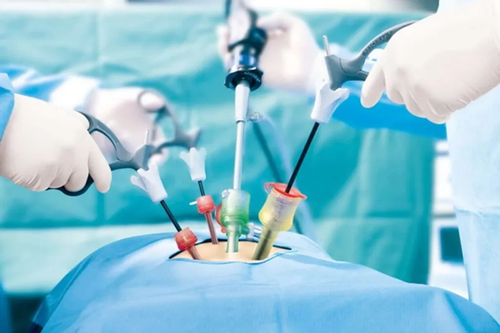 laparoscopic-hernia-surgery-costs-in-bangalore