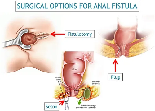 fistula-surgery-procedure-recovery-and-aftercare-tips