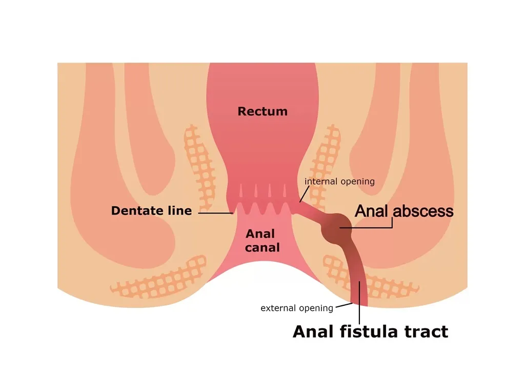 fistula-laser-surgery-cost-in-hsr-layout