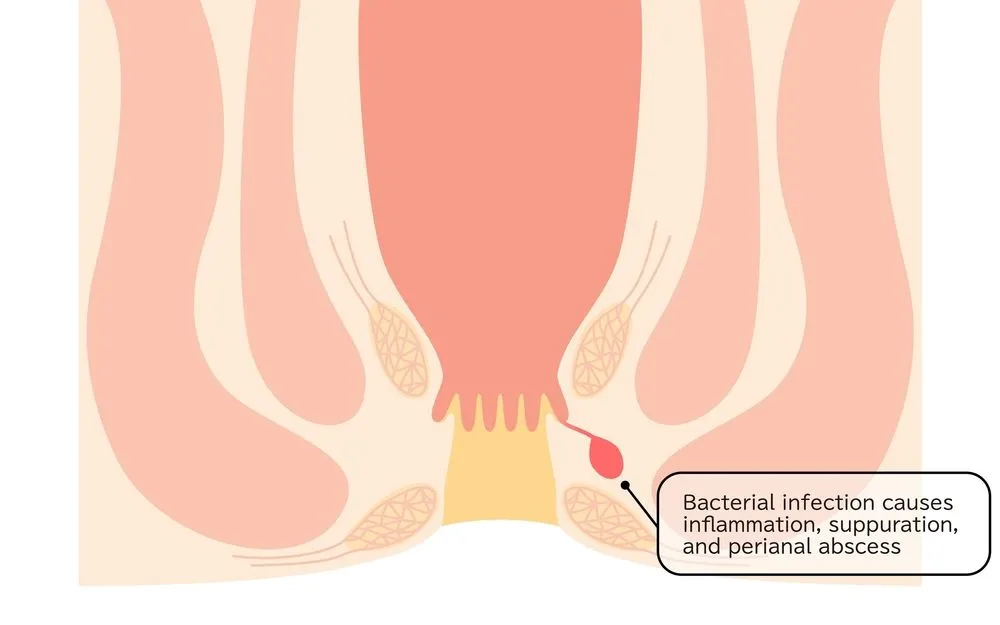 Perianal abscess treatment in Bangalore with specialized colorectal care at Smiles Hospital