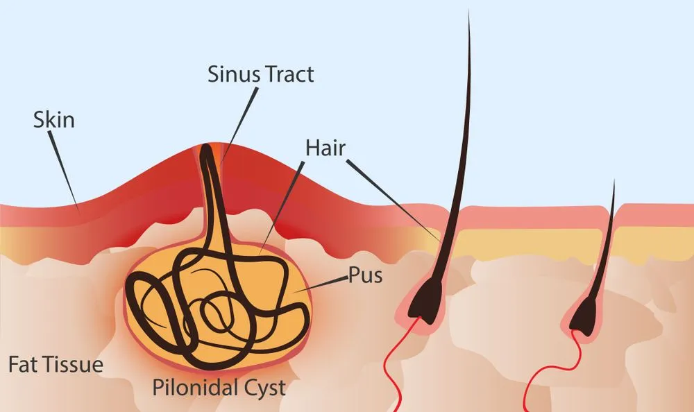Laser pilonidal sinus surgery in Bangalore for painless recovery and faster healing