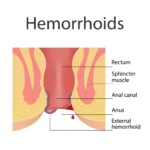 Qualified piles doctor in Indiranagar with laser expertise