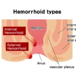 Trusted piles doctor in JP Nagar providing advanced care