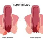 Specialist piles doctor in Shivaji Nagar offering safe treatment