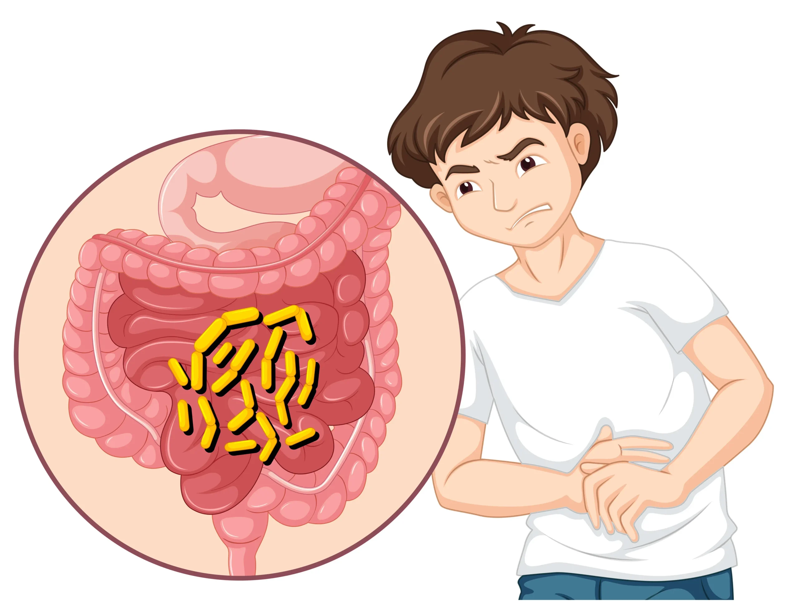 Illustration of a person experiencing abdominal discomfort related to IBS, with an anatomical diagram of intestines showing gut bacteria, highlighting symptoms like bloating and cramping.